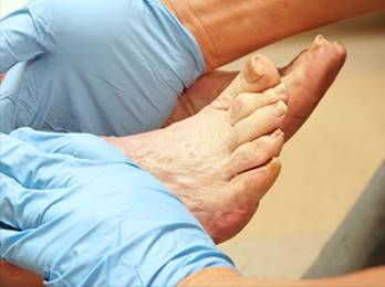 Diabetic Foot Treatment in the Los Angeles County, CA: Lancaster (Lake Los Angeles, Palmdale, Oban, Antelope Acres, Del Sur, Quartz Hill, Desert View Highlands, Leona Valley); Kern County, CA: Rosamond, Tehachapi, North Edwards; San Mateo County, CA: Roosevelt, and Riverside County, CA: Lakeview areas