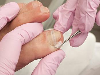 Ingrown Nail Treatment in the Los Angeles County, CA: Lancaster (Lake Los Angeles, Palmdale, Oban, Antelope Acres, Del Sur, Quartz Hill, Desert View Highlands, Leona Valley); Kern County, CA: Rosamond, Tehachapi, North Edwards; San Mateo County, CA: Roosevelt, and Riverside County, CA: Lakeview areas