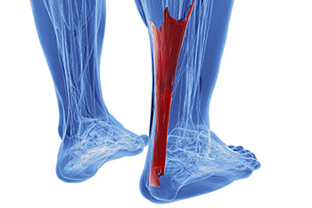 Achilles tendon treatment in the Los Angeles County, CA: Lancaster (Lake Los Angeles, Palmdale, Oban, Antelope Acres, Del Sur, Quartz Hill, Desert View Highlands, Leona Valley); Kern County, CA: Rosamond, Tehachapi, North Edwards; San Mateo County, CA: Roosevelt, and Riverside County, CA: Lakeview areas
