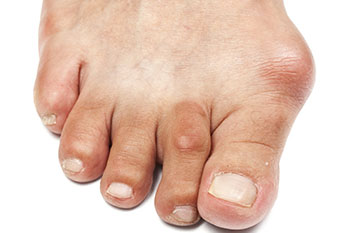 Bunions treatment and removal in the Los Angeles County, CA: Lancaster (Lake Los Angeles, Palmdale, Oban, Antelope Acres, Del Sur, Quartz Hill, Desert View Highlands, Leona Valley); Kern County, CA: Rosamond, Tehachapi, North Edwards; San Mateo County, CA: Roosevelt, and Riverside County, CA: Lakeview areas