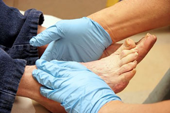 Diabetic foot treatment in the Los Angeles County, CA: Lancaster (Lake Los Angeles, Palmdale, Oban, Antelope Acres, Del Sur, Quartz Hill, Desert View Highlands, Leona Valley); Kern County, CA: Rosamond, Tehachapi, North Edwards; San Mateo County, CA: Roosevelt, and Riverside County, CA: Lakeview areas