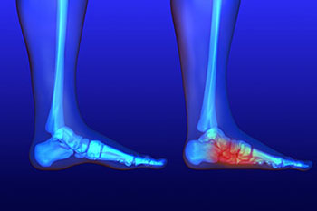 Flat feet treatment in the Los Angeles County, CA: Lancaster (Lake Los Angeles, Palmdale, Oban, Antelope Acres, Del Sur, Quartz Hill, Desert View Highlands, Leona Valley); Kern County, CA: Rosamond, Tehachapi, North Edwards; San Mateo County, CA: Roosevelt, and Riverside County, CA: Lakeview areas