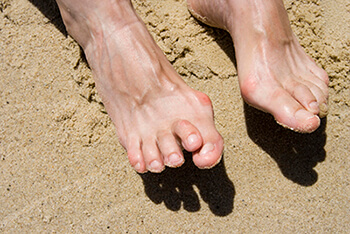 Hammertoe treatment in the Los Angeles County, CA: Lancaster (Lake Los Angeles, Palmdale, Oban, Antelope Acres, Del Sur, Quartz Hill, Desert View Highlands, Leona Valley); Kern County, CA: Rosamond, Tehachapi, North Edwards; San Mateo County, CA: Roosevelt, and Riverside County, CA: Lakeview areas