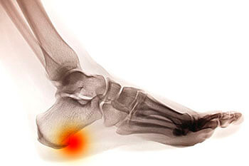 Heel spur treatment in the Los Angeles County, CA: Lancaster (Lake Los Angeles, Palmdale, Oban, Antelope Acres, Del Sur, Quartz Hill, Desert View Highlands, Leona Valley); Kern County, CA: Rosamond, Tehachapi, North Edwards; San Mateo County, CA: Roosevelt, and Riverside County, CA: Lakeview areas