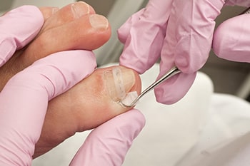Ingrown toenail treatment in the Los Angeles County, CA: Lancaster (Lake Los Angeles, Palmdale, Oban, Antelope Acres, Del Sur, Quartz Hill, Desert View Highlands, Leona Valley); Kern County, CA: Rosamond, Tehachapi, North Edwards; San Mateo County, CA: Roosevelt, and Riverside County, CA: Lakeview areas