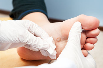 Warts treatment in the Los Angeles County, CA: Lancaster (Lake Los Angeles, Palmdale, Oban, Antelope Acres, Del Sur, Quartz Hill, Desert View Highlands, Leona Valley); Kern County, CA: Rosamond, Tehachapi, North Edwards; San Mateo County, CA: Roosevelt, and Riverside County, CA: Lakeview areas