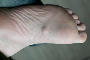 Definition and Causes of Plantar Fibromatosis