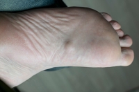 Definition and Causes of Plantar Fibromatosis