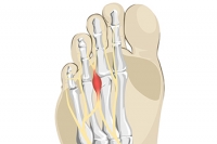 All About Morton’s Neuroma