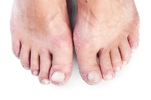 Understanding How Psoriatic Arthritis Affects the Feet