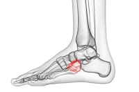 Difficult Identification of Cuboid Syndrome