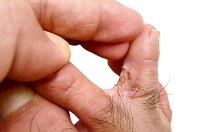 Causes and Symptoms of Athlete’s Foot