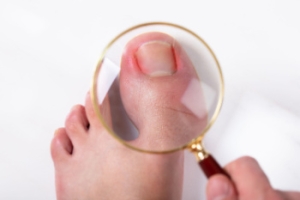 Ingrown Toenails and Foot Health