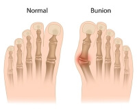 Bunion Relief