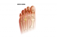 Podiatric Care For Morton’s Neuroma