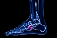 Causes of Cuboid Syndrome