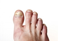 Ways to Avoid Toenail Fungus