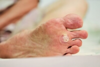 Causes of Plantar Warts