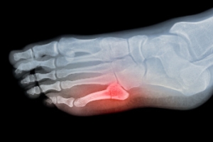 Identifying a Toe Fracture